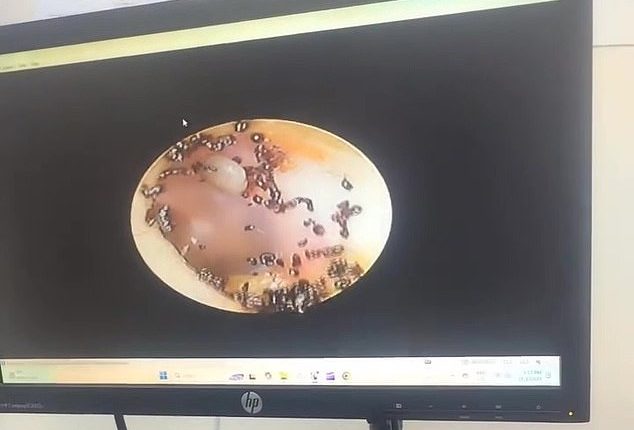 Hayfar Nasir, from Malaysia, was found to have an infestation of ticks inside her ear