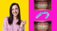 Is Invisalign worth it? My results speak for themselves