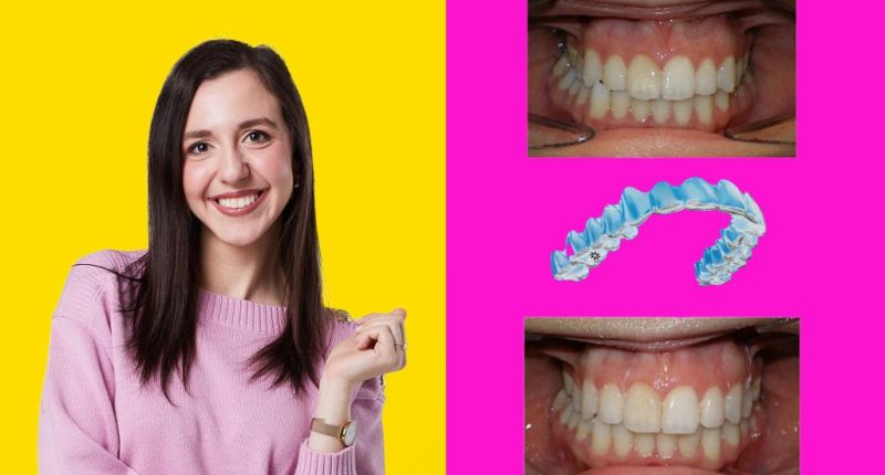 Is Invisalign worth it? My results speak for themselves