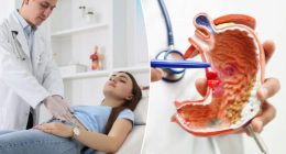 6 early signs of stomach cancers as young adult cases rise in the US