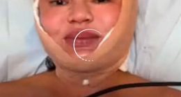 Chrissy Teigen shared a very alarming photo to her Insta Stories on Thursday. The Sports Illustrated Swimsuit model was seen with a beige bandage under her chin, around her cheeks and on top of her head as she went makeup-free