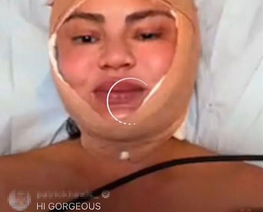 Chrissy Teigen shared a very alarming photo to her Insta Stories on Thursday. The Sports Illustrated Swimsuit model was seen with a beige bandage under her chin, around her cheeks and on top of her head as she went makeup-free