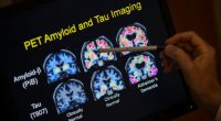 FDA approves blood test that can help diagnose Alzheimer’s disease