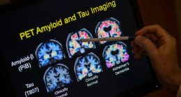 FDA approves blood test that can help diagnose Alzheimer’s disease