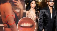 Halle Bailey claims ex DDG viciously attacked her multiple times, shares photos of bruises and chipped tooth