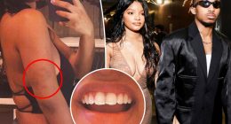 Halle Bailey claims ex DDG viciously attacked her multiple times, shares photos of bruises and chipped tooth