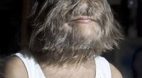 The 2010 Guinness World Record holder for 'hairiest teenager' is prone to growing thick hair all over her face, ears, arms, legs and back