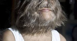 The 2010 Guinness World Record holder for 'hairiest teenager' is prone to growing thick hair all over her face, ears, arms, legs and back