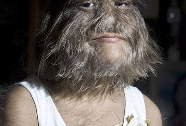 The 2010 Guinness World Record holder for 'hairiest teenager' is prone to growing thick hair all over her face, ears, arms, legs and back