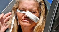 Danniella Westbrook seen in bandages after surgeons use cartilage from her rib to fix her nose in life changing op