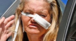 Danniella Westbrook seen in bandages after surgeons use cartilage from her rib to fix her nose in life changing op