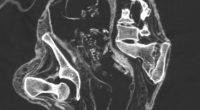 The mystery surrounding the bizarre ' alien ' mummies found in Peru has deepened after scientists said they discovered a fetus inside the womb of one of the 'corpses'. CT scans (pictured) captured the fetus lying on its back