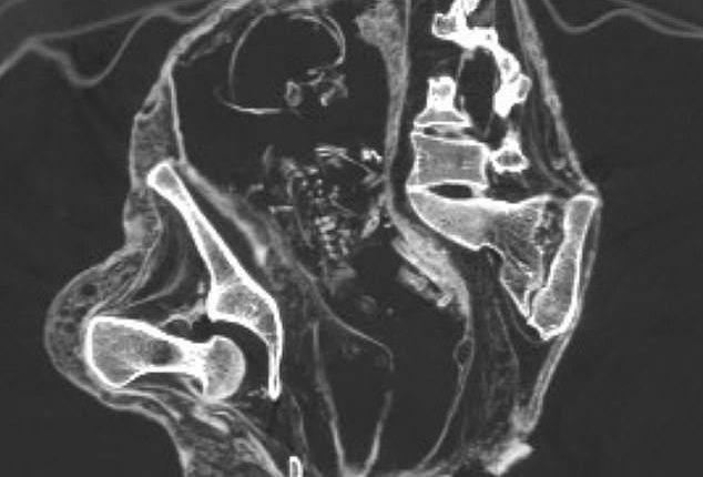 The mystery surrounding the bizarre ' alien ' mummies found in Peru has deepened after scientists said they discovered a fetus inside the womb of one of the 'corpses'. CT scans (pictured) captured the fetus lying on its back
