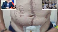 Ukrainian soldier branded with ‘Glory to Russia’ burned on his skin while in Russian captivity