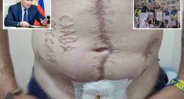 Ukrainian soldier branded with ‘Glory to Russia’ burned on his skin while in Russian captivity