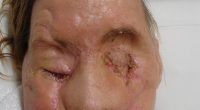 In February 2009, Charla Nash was attacked by her friend Sandra Herold¿s chimpanzee, Travis, at her home in Connecticut , who ripped off her nose, lips, eyelids and hands
