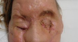 In February 2009, Charla Nash was attacked by her friend Sandra Herold¿s chimpanzee, Travis, at her home in Connecticut , who ripped off her nose, lips, eyelids and hands