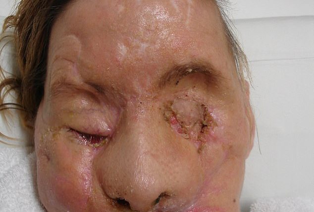 In February 2009, Charla Nash was attacked by her friend Sandra Herold¿s chimpanzee, Travis, at her home in Connecticut , who ripped off her nose, lips, eyelids and hands