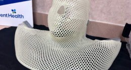 A radiotherapy mask that immobilizes the patient during radiation therapy. (© FlaglerLive)