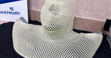 A radiotherapy mask that immobilizes the patient during radiation therapy. (© FlaglerLive)