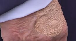 The makeup appeared to be covering a circular protrusion of skin that doctors told the Daily Mail was most likely the after-effect of a routine blood draw