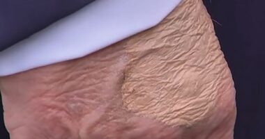 The makeup appeared to be covering a circular protrusion of skin that doctors told the Daily Mail was most likely the after-effect of a routine blood draw