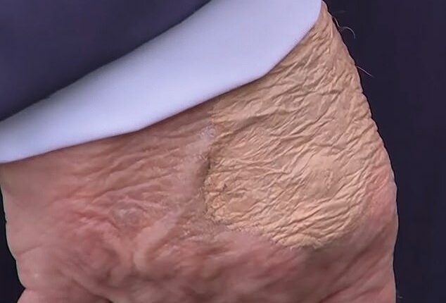 The makeup appeared to be covering a circular protrusion of skin that doctors told the Daily Mail was most likely the after-effect of a routine blood draw