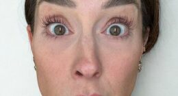 A nurse who got Botox injected on only one side of her face to show others how it really affects your looks has revealed the shocking results. She's seen before getting the Botox