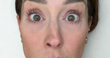 A nurse who got Botox injected on only one side of her face to show others how it really affects your looks has revealed the shocking results. She's seen before getting the Botox