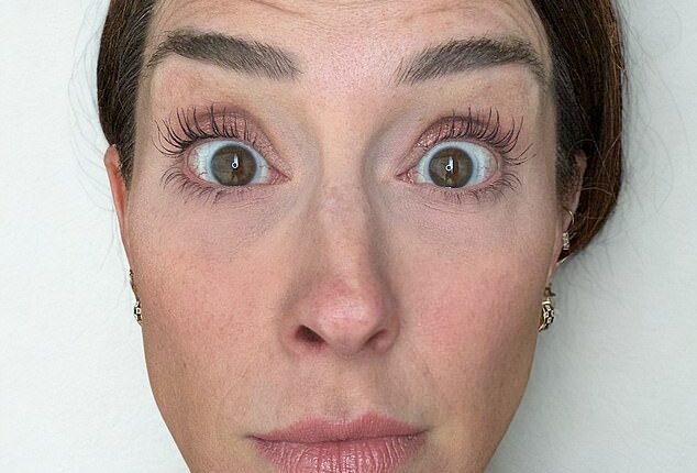 A nurse who got Botox injected on only one side of her face to show others how it really affects your looks has revealed the shocking results. She's seen before getting the Botox