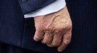 White House press secretary Karoline Leavitt says that Trump has been diagnosed with 'chronic venous insufficiency'