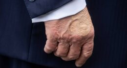 White House press secretary Karoline Leavitt says that Trump has been diagnosed with 'chronic venous insufficiency'