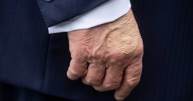 White House press secretary Karoline Leavitt says that Trump has been diagnosed with 'chronic venous insufficiency'