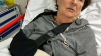 Koljibabic said the very painful impact shattered her wrist, requiring surgery and a metal plate